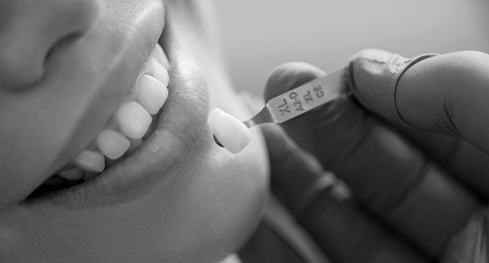 Faccette Dentali