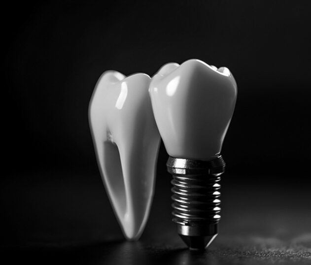 Impianti Dentali