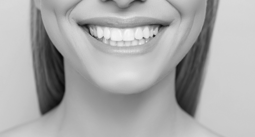 Sbiancamento Dentale